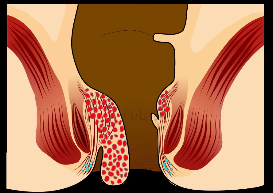 Hemoroid (Basur) Hastalığı Nedir?